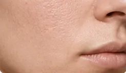 Improves Skin Texture