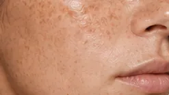 Helps Even Skin Tone