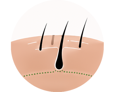 Promote regrowth