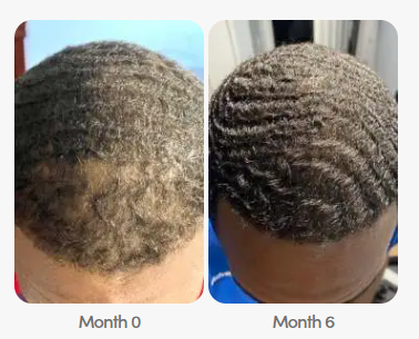 Hair Loss Reducer