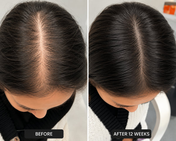 Hair Loss Reducer